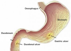 Tratamentul homeopatic al gastritei, ulcerului gastric si duodenal